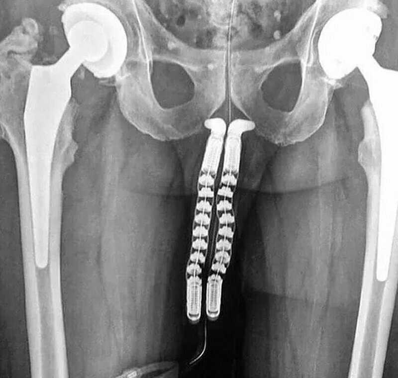 На фото: процесс смены пола: вы видите рентген-снимок пациента на этапе трансплантации полового органа
