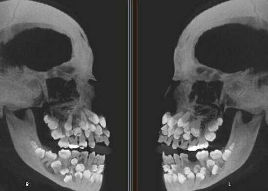 А это снимок человека с гипердонтией (аномалия числа зубов)