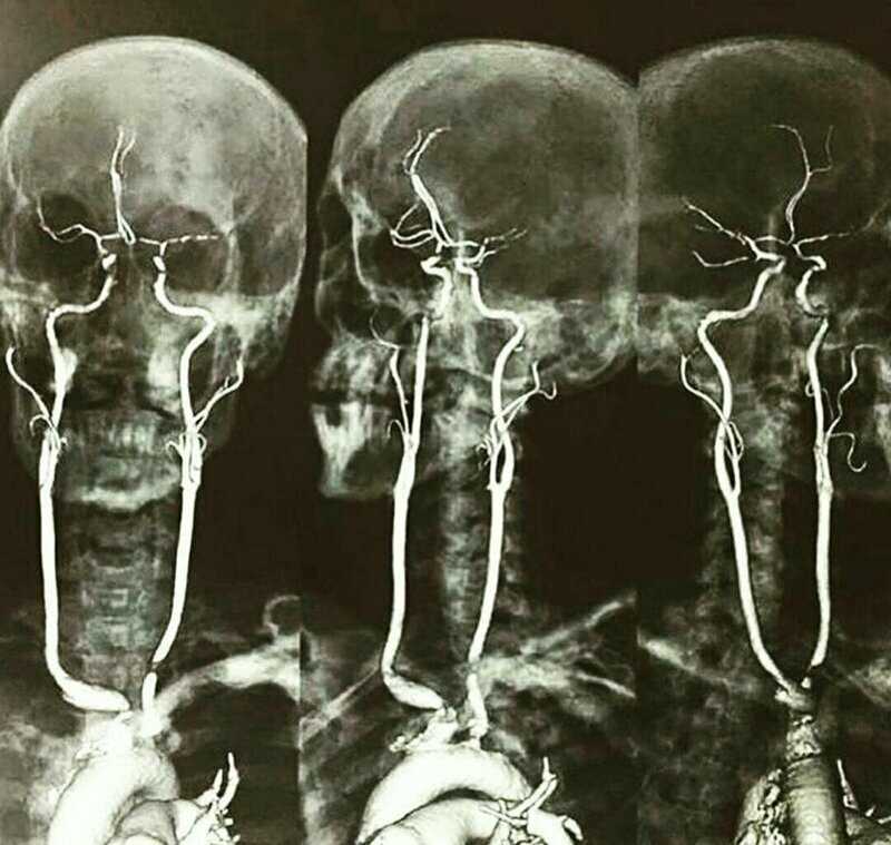 А это рентген с контрастированием сонных артерий. Выглядит жутковато только для непосвященных